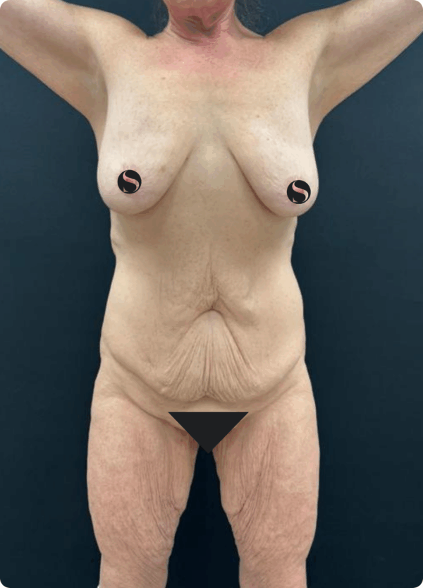Body Lift - 081 - Image 3