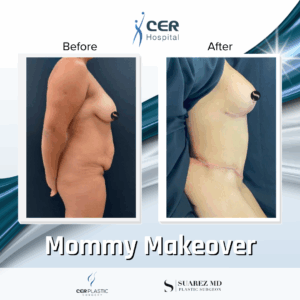 Mommy Makeover – 061