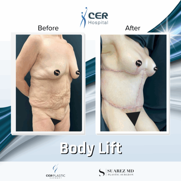 Body Lift - 131 - Image 4