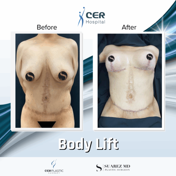 Body Lift - 201 - Image 4