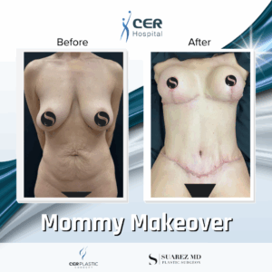 Mommy Makeover – 063