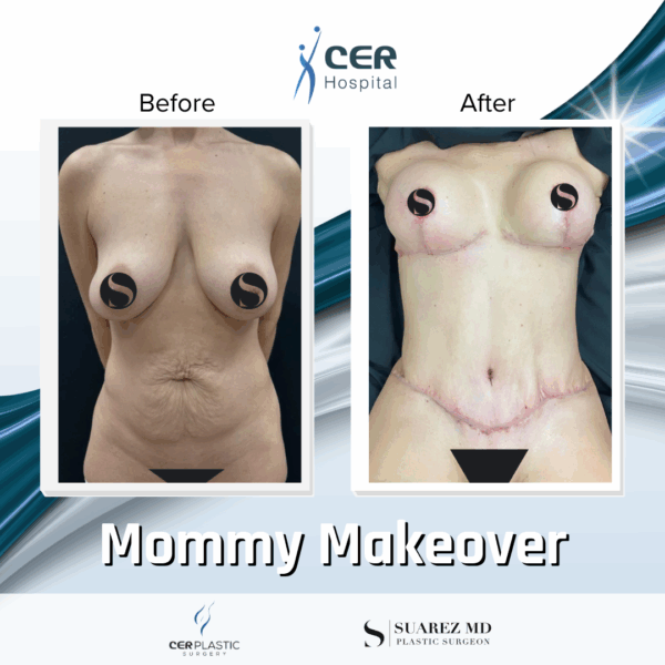 Mommy Makeover - 063