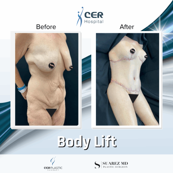 Body Lift - 081 - Image 4
