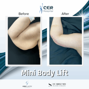 Mini Body Lift – 193