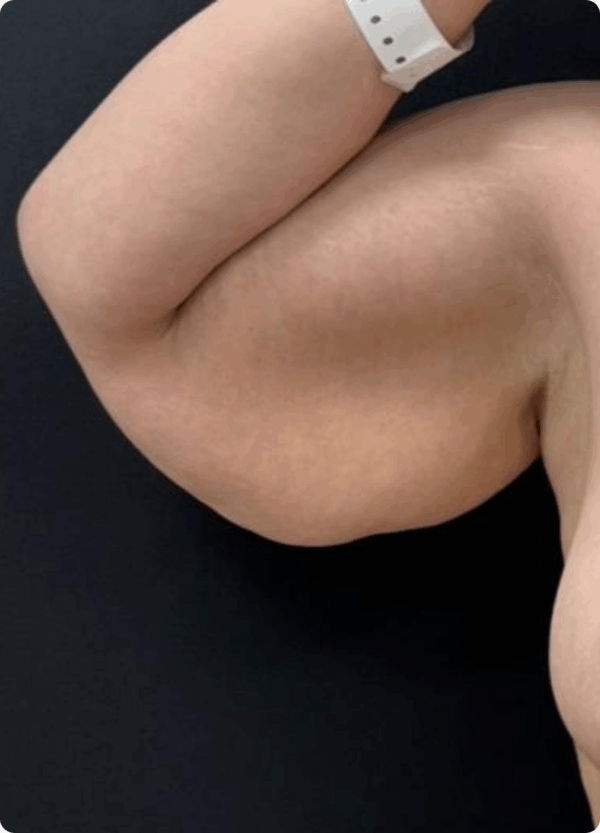 Mini Body Lift - 193 - Image 3