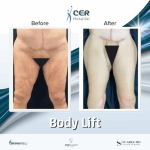 Body Lift – 243