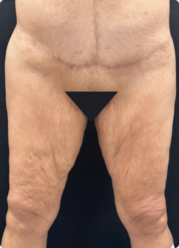 Body Lift - 243 - Image 3