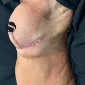 Breast Reduction – 042