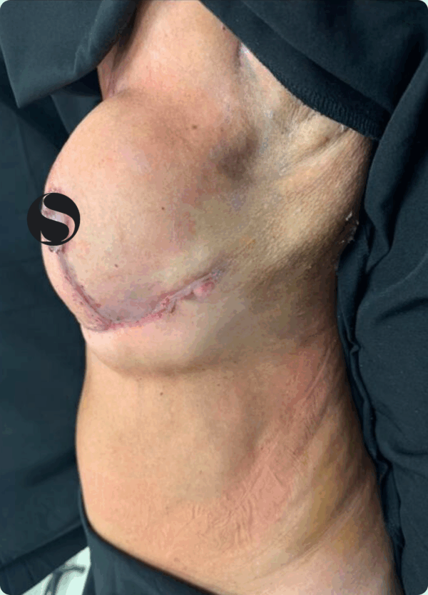 Breast Reduction - 042 - Image 2