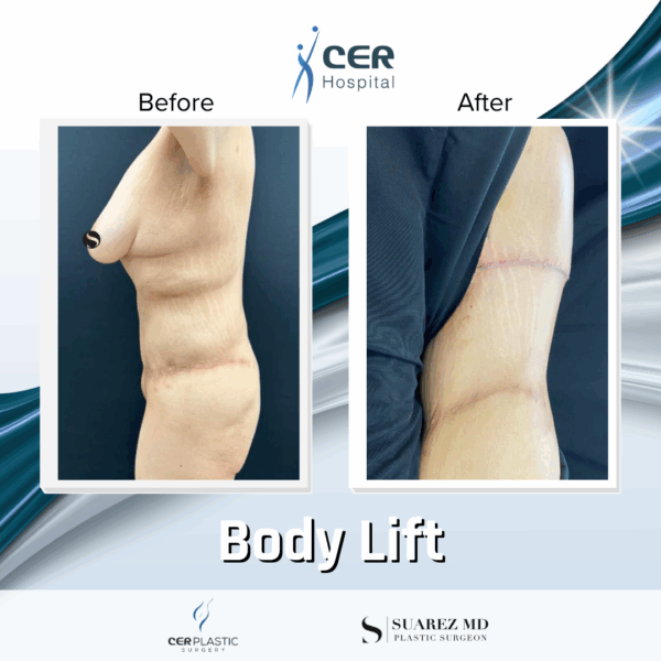 Body Lift - 201 - Image 12