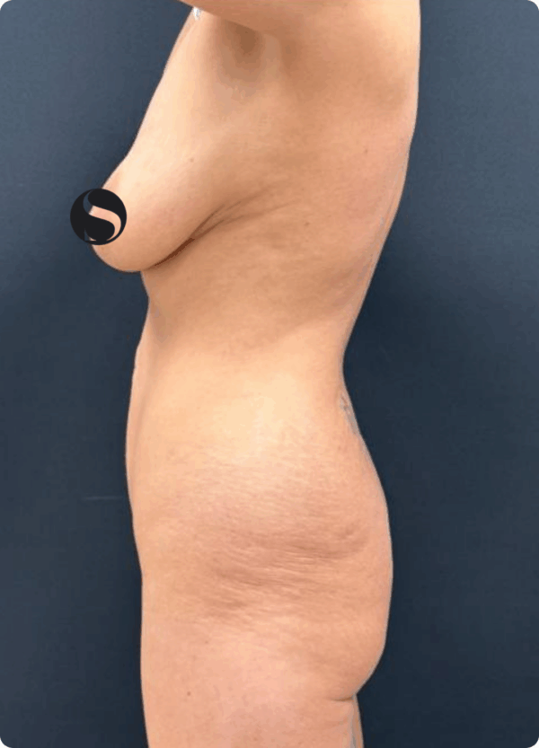 Body Lift - 125 - Image 3
