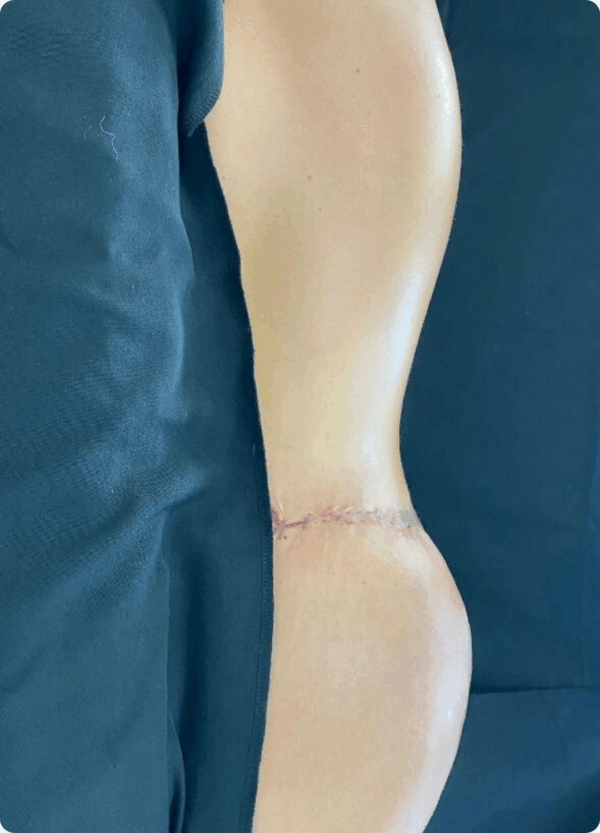 Body Lift - 125 - Image 2