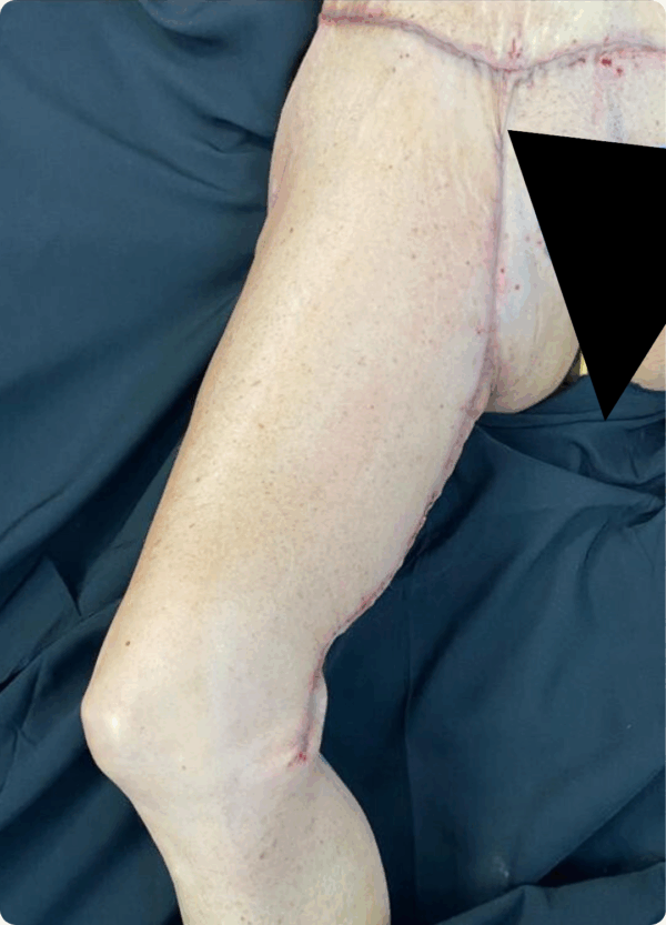 Body Lift - 291 - Image 2