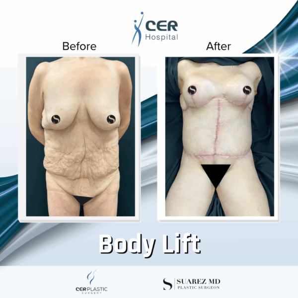Body Lift - 131 - Image 5