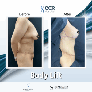Body Lift – 201