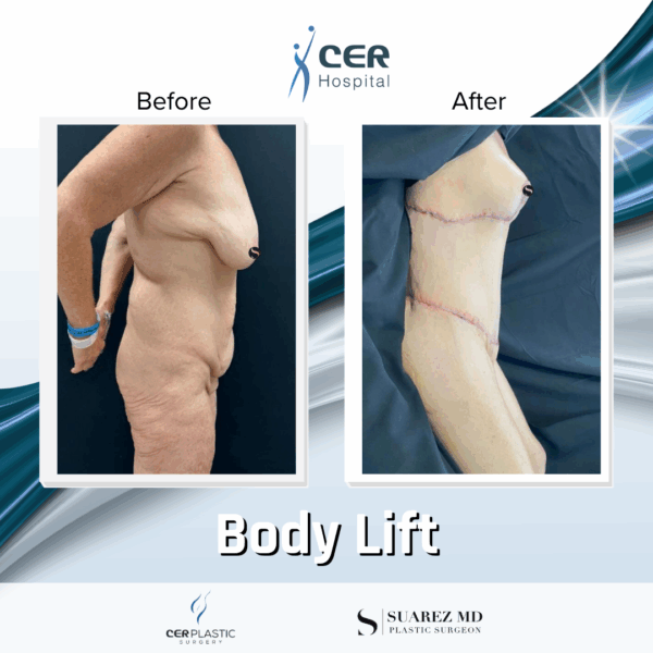 Body Lift - 081 - Image 5