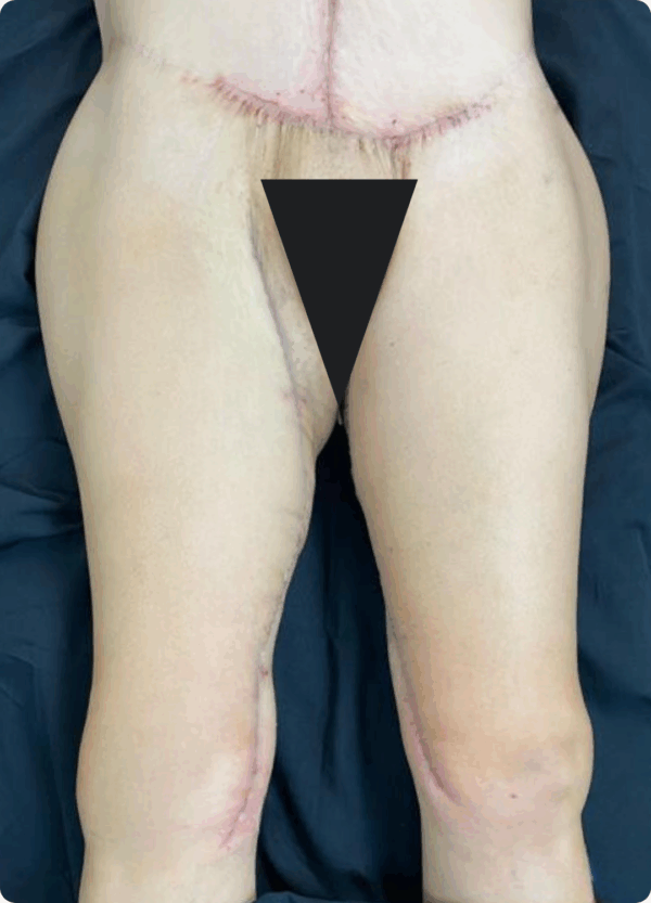 Body Lift - 243 - Image 2