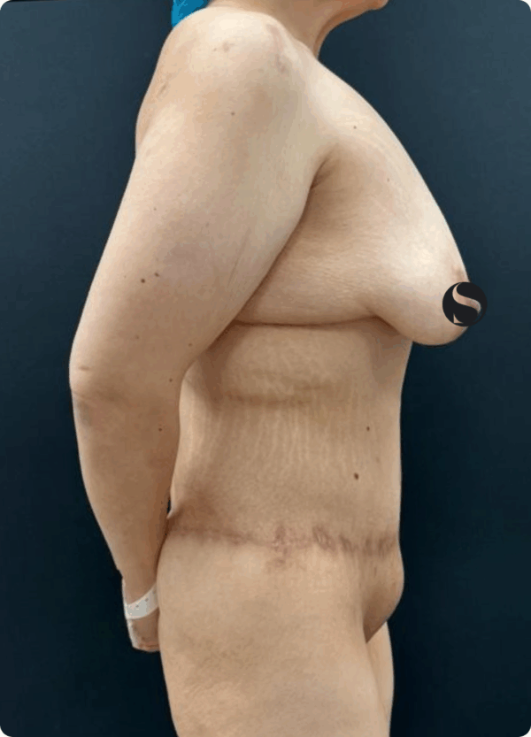 Body Lift - 201 - Image 3