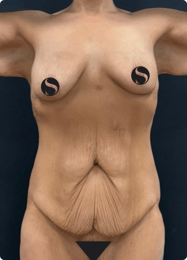 Body Lift - 304 - Image 3