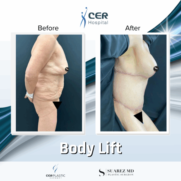 Body Lift - 131 - Image 6