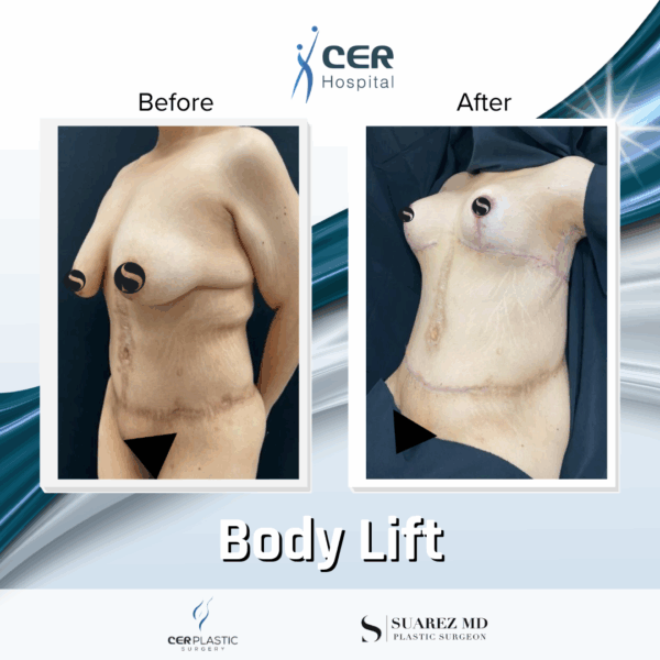 Body Lift - 201 - Image 5