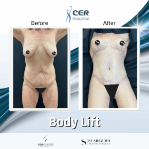 Body Lift – 081