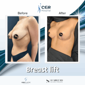 Breast Lift – 103