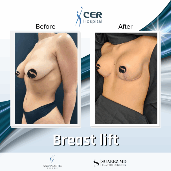 Breast Lift - 103