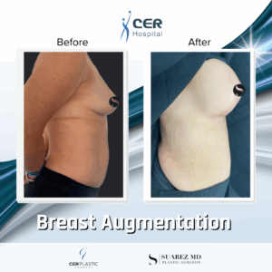 Breast Augmentation – 103