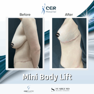 Body Lift – 094