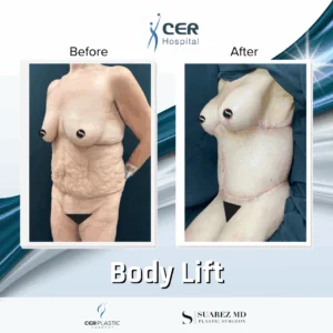 Body Lift – 131