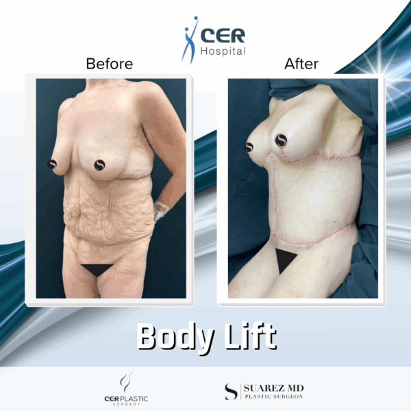 Body Lift - 131