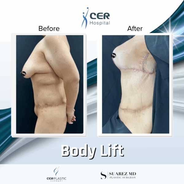 Body Lift - 201 - Image 6