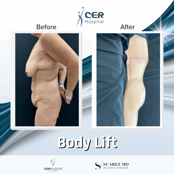 Body Lift - 081 - Image 6