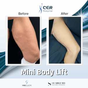 Mini Body Lift – 073
