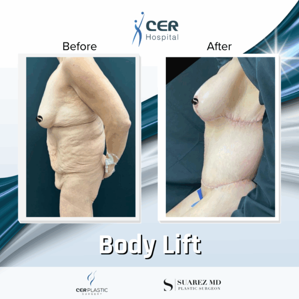 Body Lift - 131 - Image 7