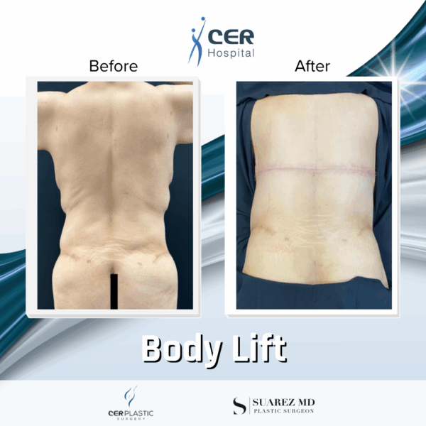 Body Lift - 201 - Image 7