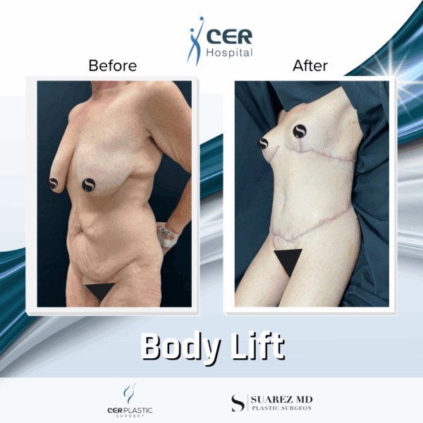 Body Lift - 081 - Image 7