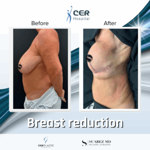 Breast Reduction – 042