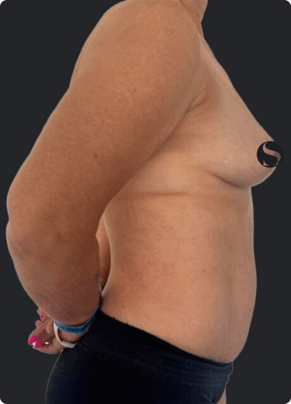 Breast Augmentation - 103 - Image 3