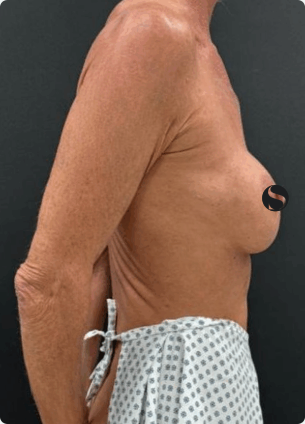 Breast Lift with Implants Exchange - 214 - Image 3