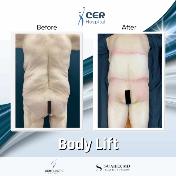 Body Lift - 131 - Image 8