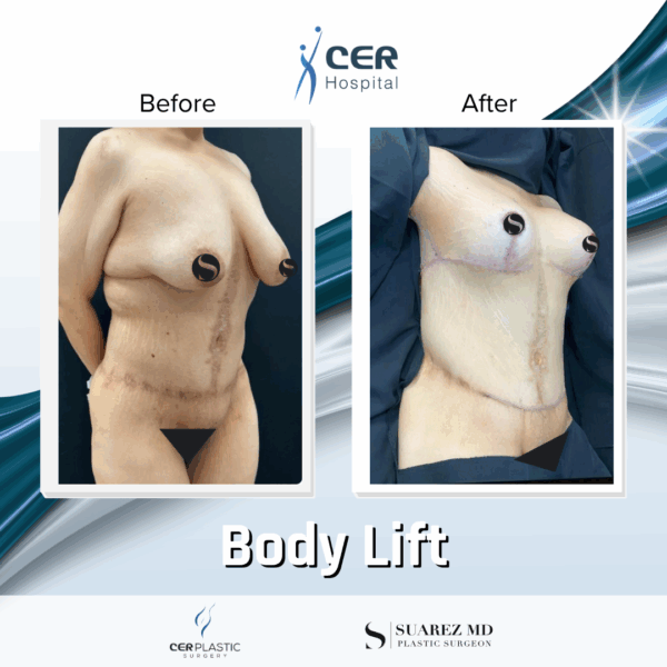 Body Lift - 201 - Image 8