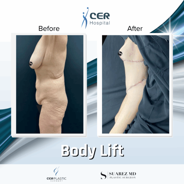 Body Lift - 081 - Image 8