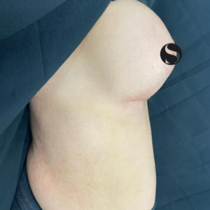 Breast Augmentation – 103