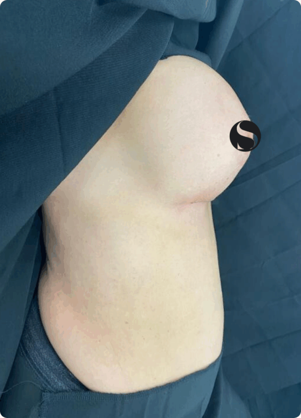 Breast Augmentation - 103 - Image 2