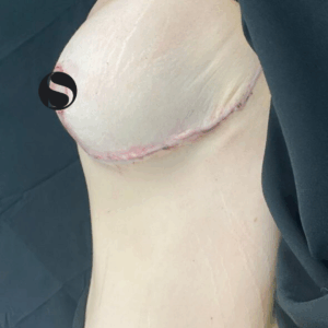 Body Lift – 094