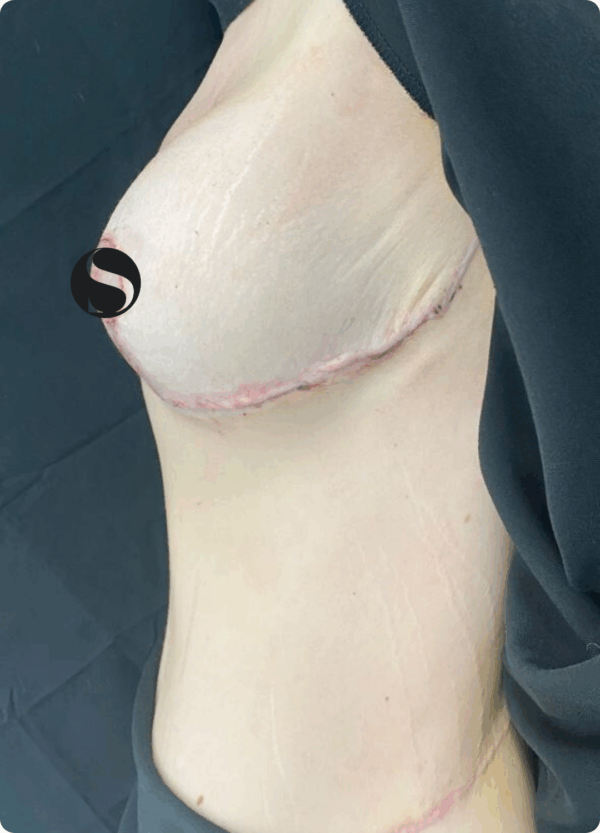 Body Lift - 094 - Image 2