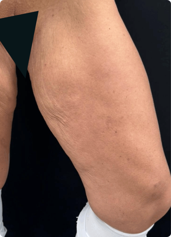 Mini Body Lift - 073 - Image 3