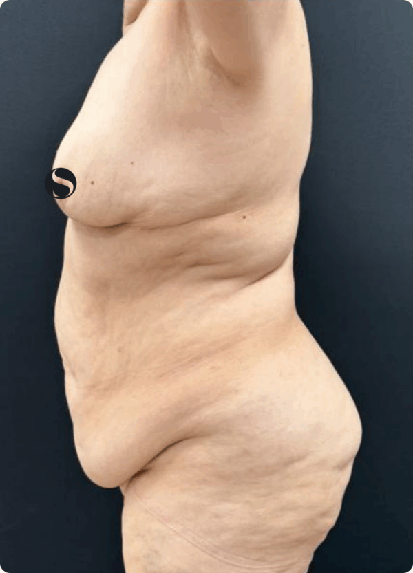 Body Lift - 144 - Image 3